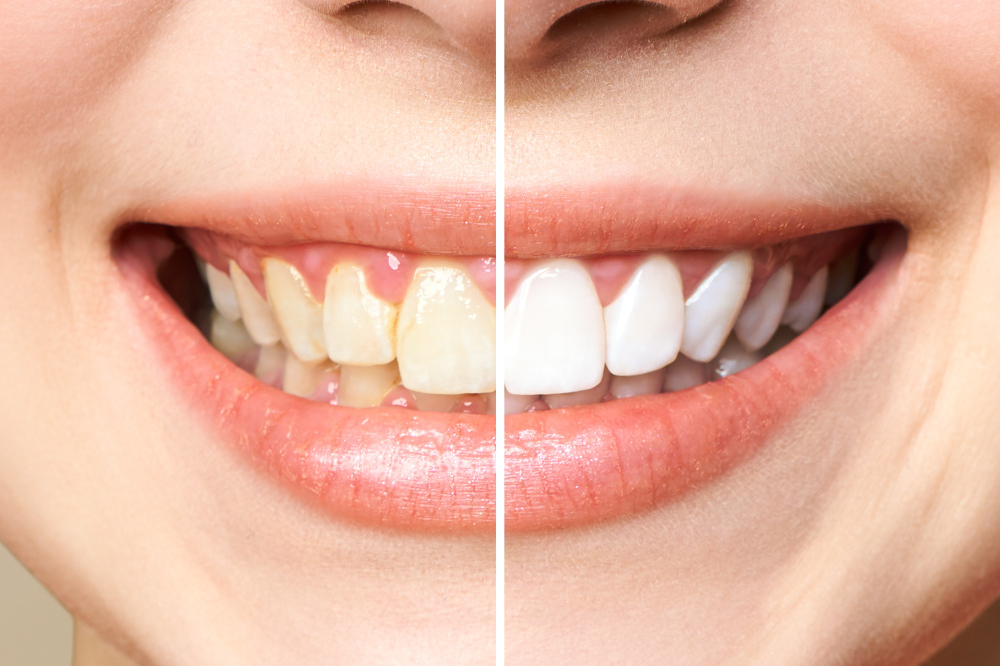 Teeth Whitening in Amesbury